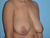 Patient # 13841 Before Photo # 1