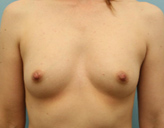 Patient # 79380 Before Photo # 1