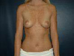 Patient # 17495 Before Photo # 1