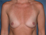 Patient # 49397 Before Photo # 1