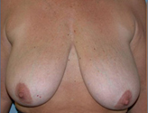 Patient # 84604 Before Photo # 1
