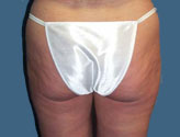 Patient # 49175 After Photo # 6