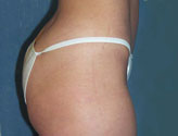 Patient # 49175 Before Photo # 3