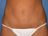 Patient # 39843 After Photo # 2