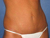 Patient # 39843 After Photo # 4