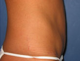 Patient # 39843 After Photo # 6