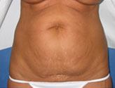 Patient # 39843 Before Photo # 1