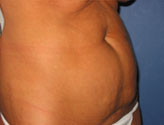 Patient # 39843 Before Photo # 3