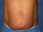 Patient # 43140 Before Photo # 1