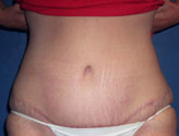 Patient # 24557 After Photo # 2