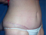 Patient # 24557 After Photo # 4