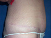 Patient # 24557 After Photo # 6