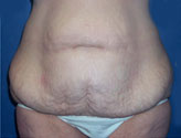 Patient # 24557 Before Photo # 1