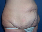 Patient # 24557 Before Photo # 3