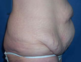 Patient # 24557 Before Photo # 5
