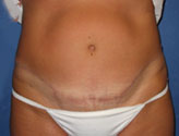 Patient # 35030 After Photo # 2