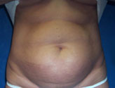 Patient # 35030 Before Photo # 1