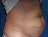 Patient # 35030 Before Photo # 3