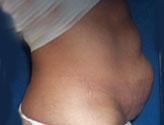 Patient # 35030 Before Photo # 5