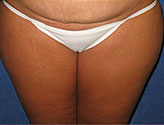 Patient # 22703 Before Photo # 1