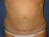 Patient # 13868 After Photo # 2