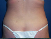 Patient # 74755 Before Photo # 5