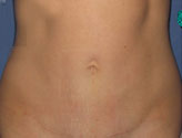 Patient # 47290 After Photo # 2