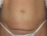 Patient # 47290 Before Photo # 1