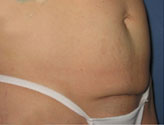 Patient # 47290 Before Photo # 3