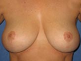 Patient # 99488 After Photo # 2