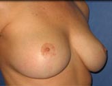 Patient # 99488 After Photo # 4