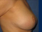 Patient # 99488 After Photo # 6
