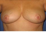 Patient # 76768 After Photo # 2