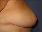 Patient # 76768 After Photo # 6