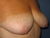 Patient # 76768 Before Photo # 3