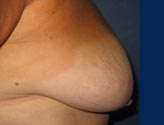 Patient # 76768 Before Photo # 5