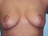 Patient # 56670 After Photo # 2
