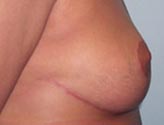 Patient # 56670 After Photo # 4