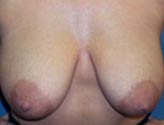 Patient # 56670 Before Photo # 1