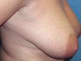Patient # 56670 Before Photo # 3