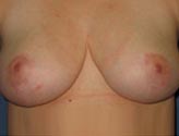 Patient # 45653 After Photo # 2