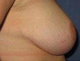 Patient # 45653 After Photo # 6
