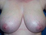Patient # 45653 Before Photo # 1