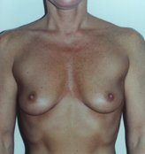 Patient # 18644 Before Photo # 1