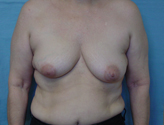 Patient # 39098 Before Photo # 1