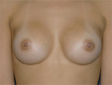 Patient # 58515 After Photo # 2