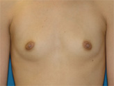 Patient # 58515 Before Photo # 1