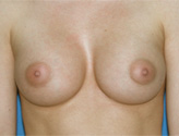 Patient # 97376 After Photo # 2