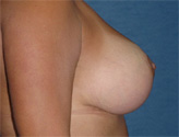 Patient # 95801 After Photo # 6