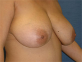 Patient # 95801 Before Photo # 3